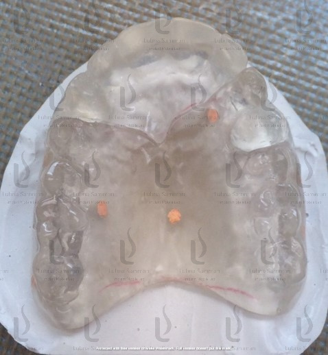 2 PC Radiographic stent