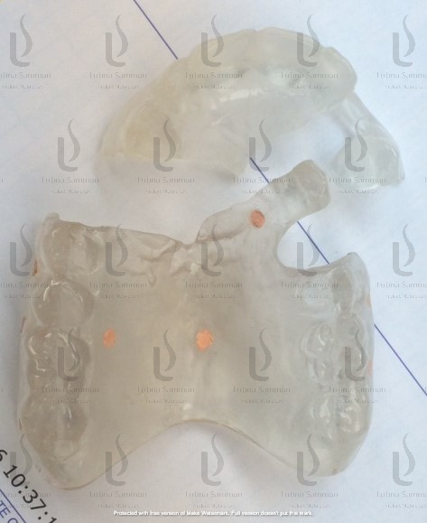 2 PC Radiographic stent