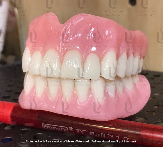 Bar Over Denture