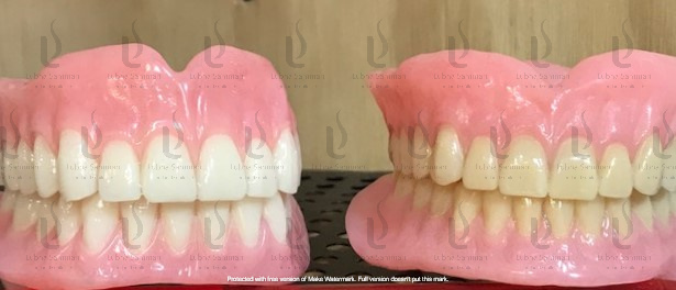 Bar Over Denture