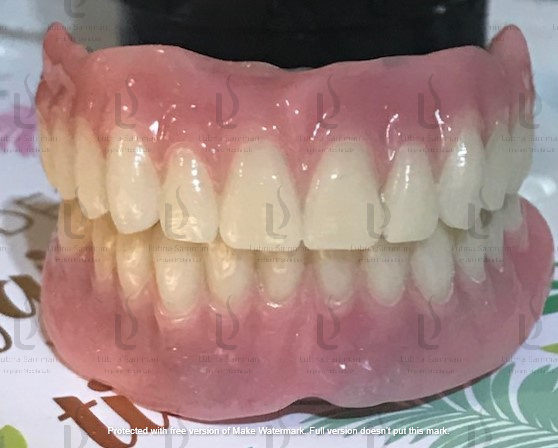 Bar Over Denture